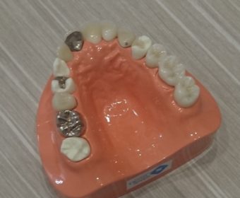 歯を削らない治療法「ＭＩ治療」とは？