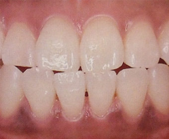 ホワイトニング