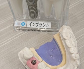 残っている歯に優しいインプラント治療