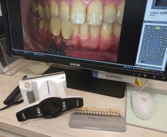 被せ物の色合わせ