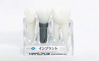 ゴアテックス　メンブレン　レジメ #歯科　　#インプラント インプラント - 藤沢の歯医者「おだがき歯科クリニック」歯周病